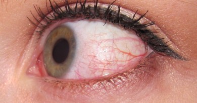 Bloodshot eye