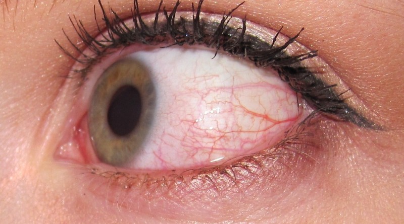 Bloodshot eye